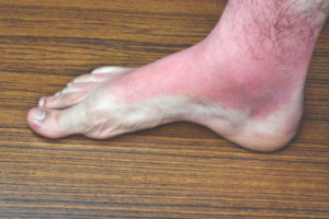 A red or dark discoloration on one leg