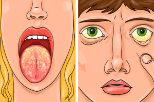 Hepatitis Appears as Allergies