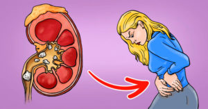 Kidney Stones Appear as Abdominal Aortic Aneurysm